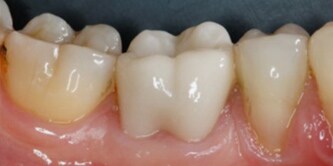 Final situation (buccal view).

