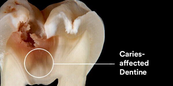 caries-affected dentin
