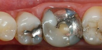 Initial situation of tooth
