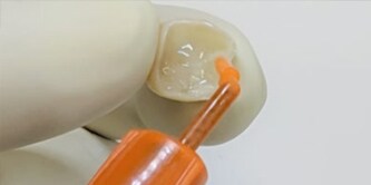 Application of 3M RelyX Universal Resin Cement.
