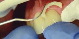 Easy excess clean-up on a tooth
