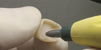 Sandblasting a tooth
