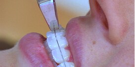 Woman having brackets debonded
