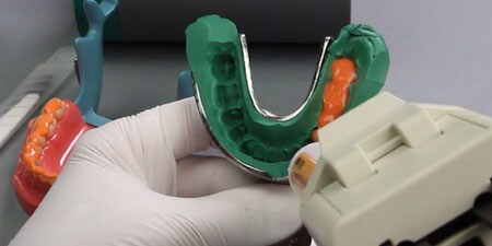 two step impression technique
