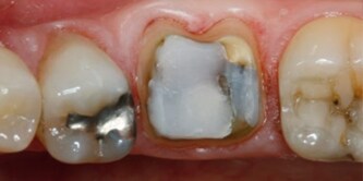 preparation of the tooth

