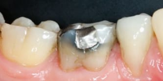 Initial situation (buccal view).

